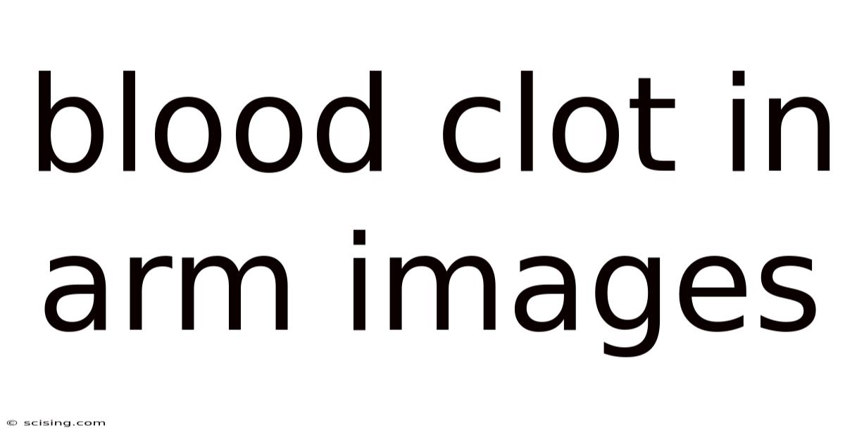 Blood Clot In Arm Images