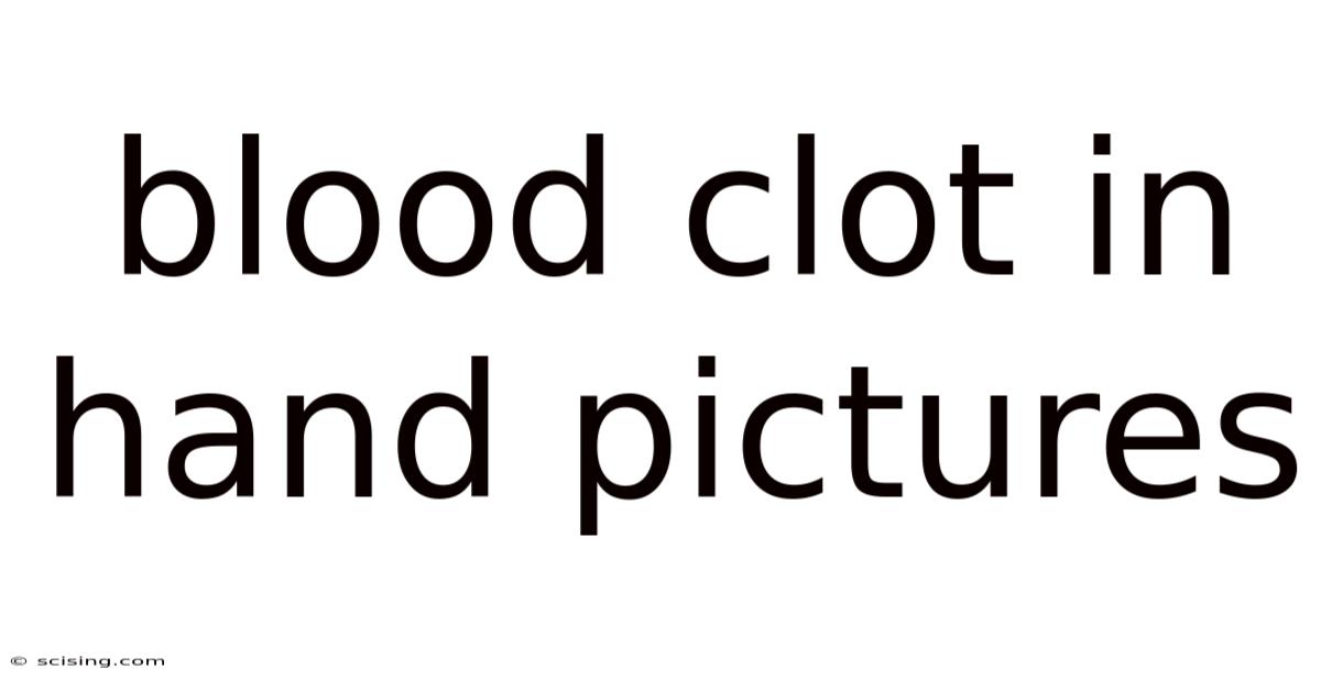 Blood Clot In Hand Pictures