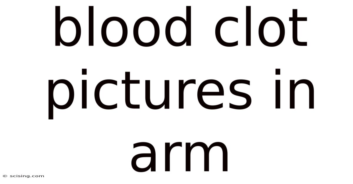 Blood Clot Pictures In Arm