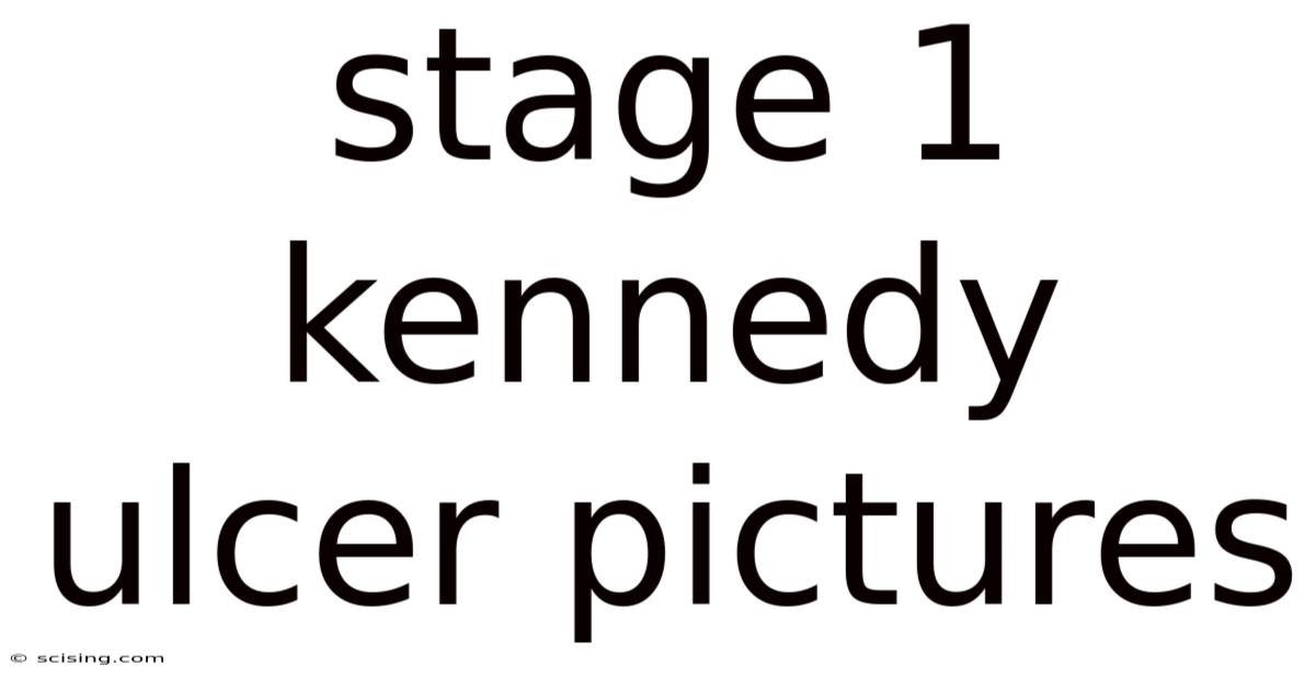 Stage 1 Kennedy Ulcer Pictures